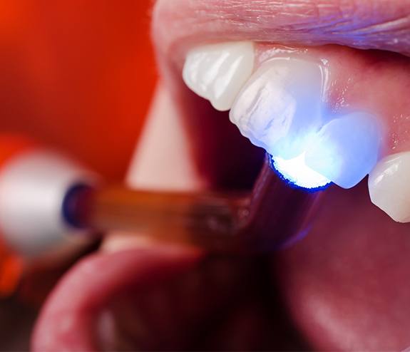 Dentist performing dental bonding treatment