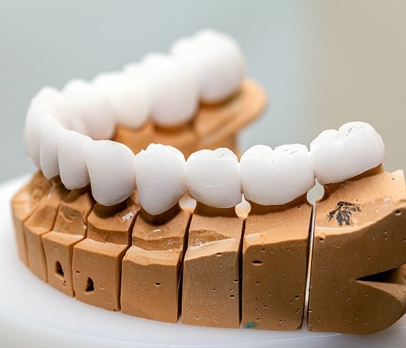 Model smile with dental implant supported denture