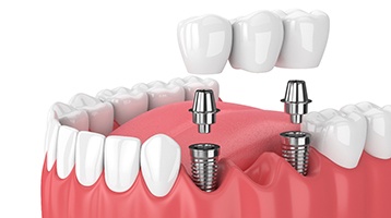 Diagram of an implant bridge replacing multiple missing teeth in Longmont