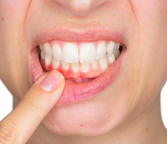 Patient with gum disease pointing to smile