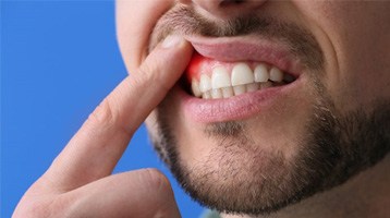 a man showing signs of gum disease