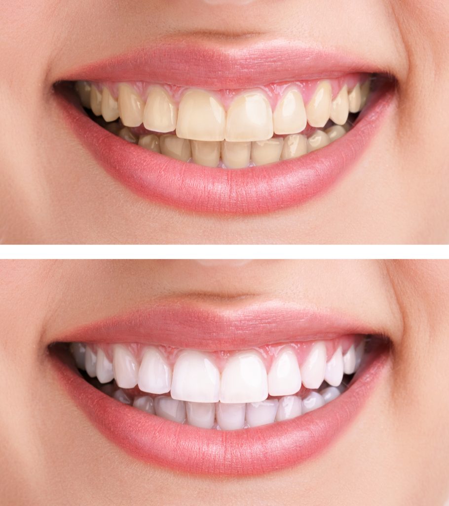 Is Hydrogen Peroxide Teeth Whitening Safe